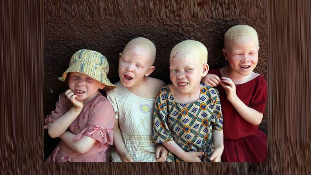 Los albinos y la brujería&nbsp;muti