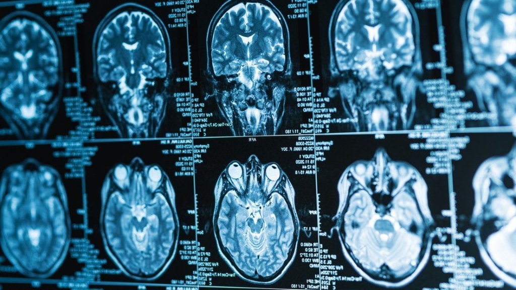 Crean un implante cerebral que convierte pensamientos en palabras en tiempo&nbsp;real